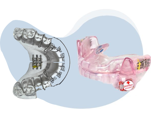 two types of aligners