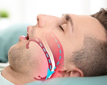 airway arrows on mans cheek