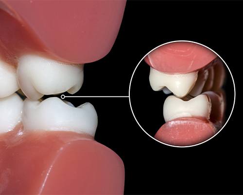 unaligned teeth