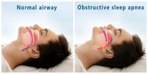 Comparison of normal and sleep apnea airway